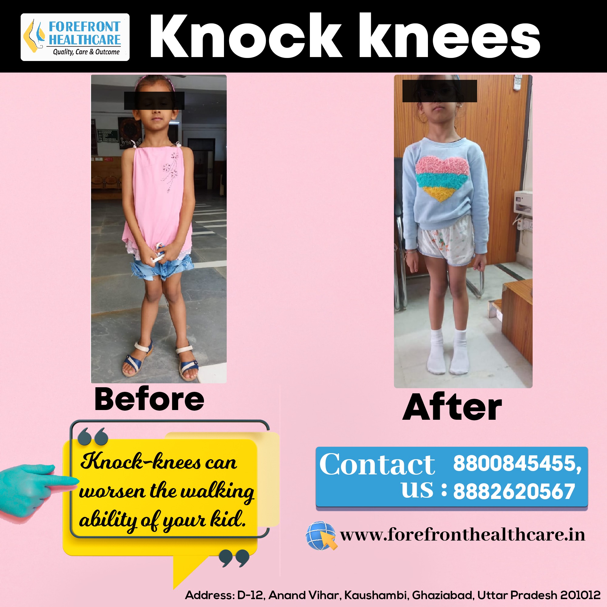 knock knee doctor in kaushambi Ghaziabad.