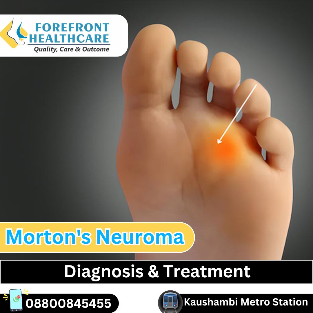 morton's neuroma diagnosis and treatment in kaushambi metro station Ghaziabad