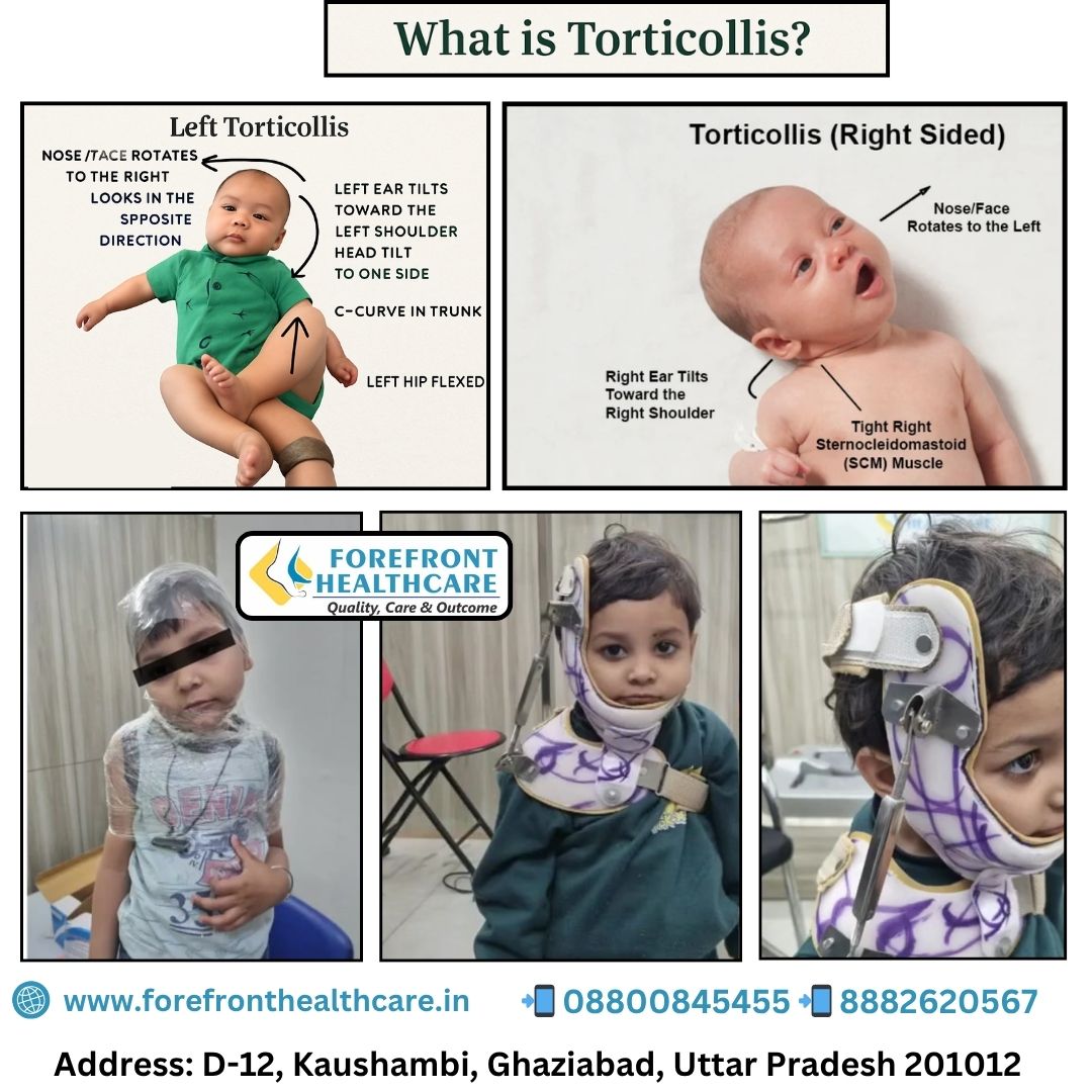 What is Torticollis? Causes, Symptoms & Treatment