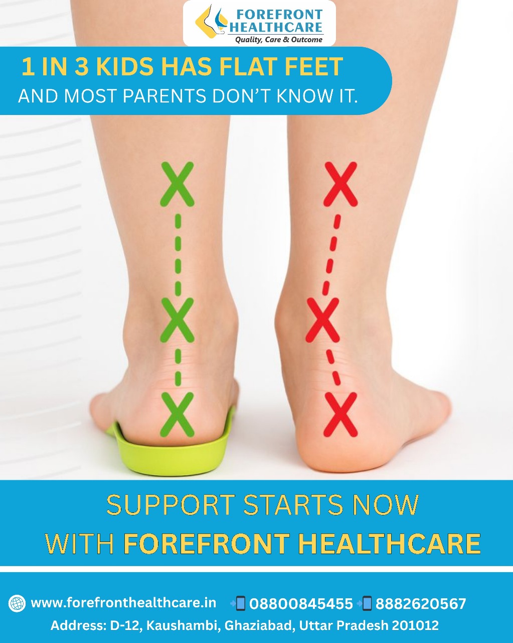 Flat feet can affect your child’s posture, balance, and walking pattern — but early diagnosis and proper support can make all the difference.
